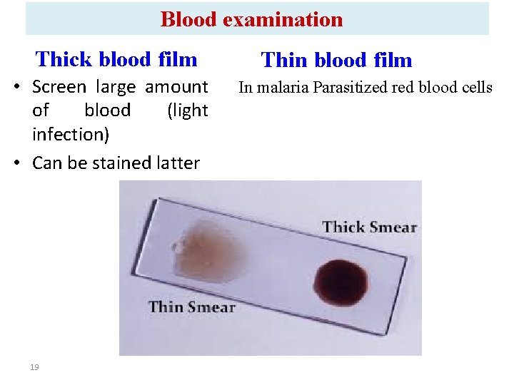 Blood examination Thick blood film • Screen large amount of blood (light infection) •