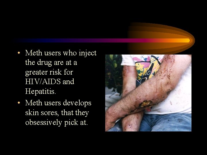  • Meth users who inject the drug are at a greater risk for