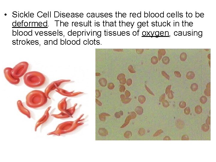  • Sickle Cell Disease causes the red blood cells to be deformed. The