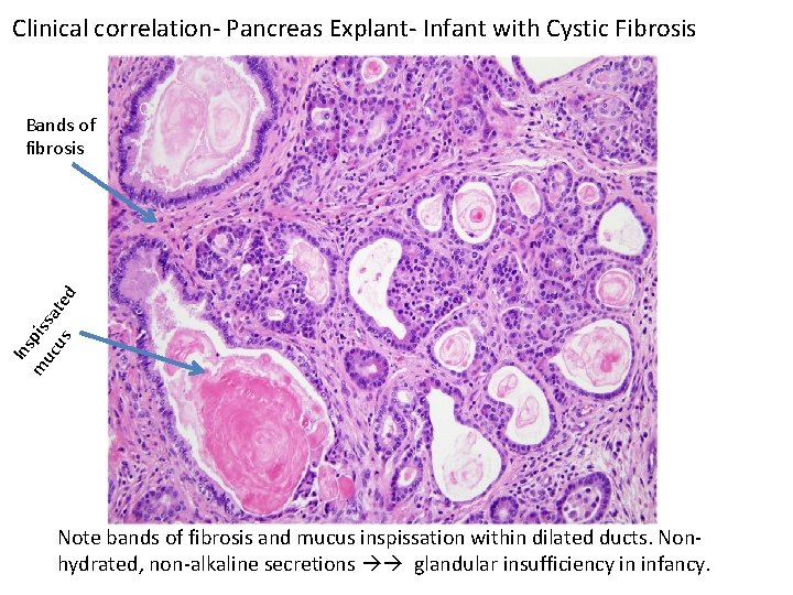 Clinical correlation- Pancreas Explant- Infant with Cystic Fibrosis C Ins m pis uc sa