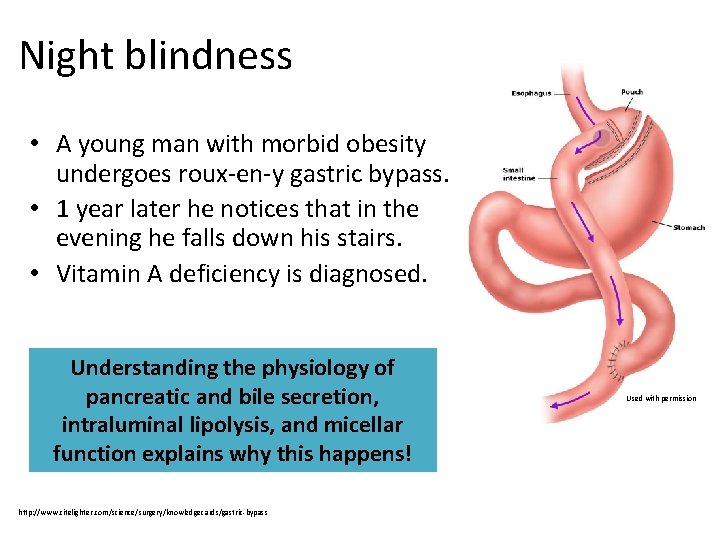Night blindness • A young man with morbid obesity undergoes roux-en-y gastric bypass. •