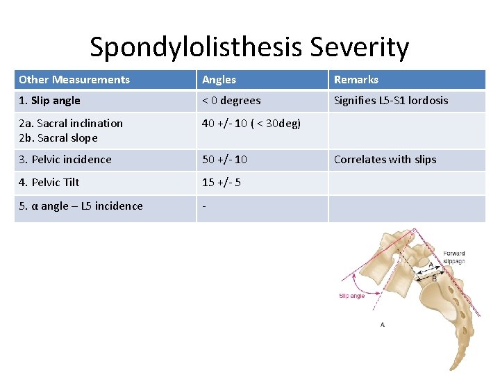 Spondylolisthesis Severity Other Measurements Angles Remarks 1. Slip angle < 0 degrees Signifies L