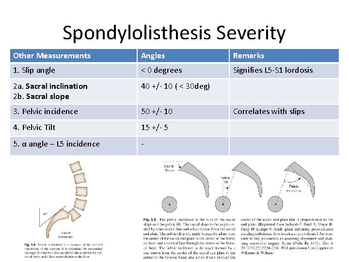 Spondylolisthesis Severity Other Measurements Angles Remarks 1. Slip angle < 0 degrees Signifies L
