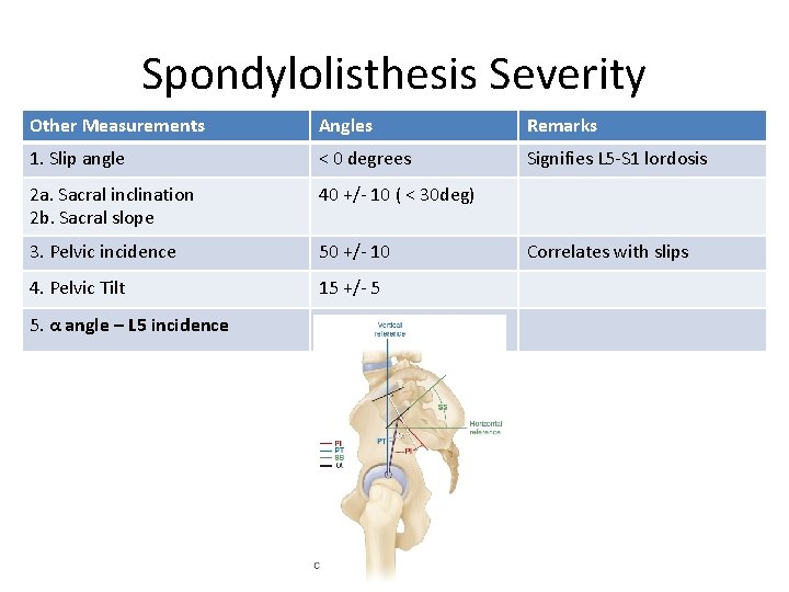 Spondylolisthesis Severity Other Measurements Angles Remarks 1. Slip angle < 0 degrees Signifies L