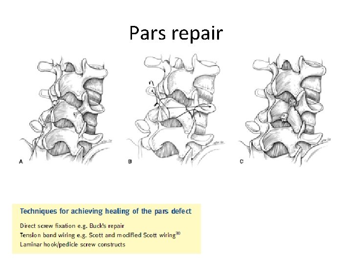 Pars repair 