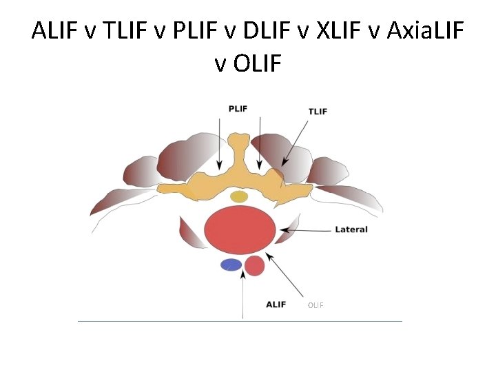 ALIF v TLIF v PLIF v DLIF v XLIF v Axia. LIF v OLIF