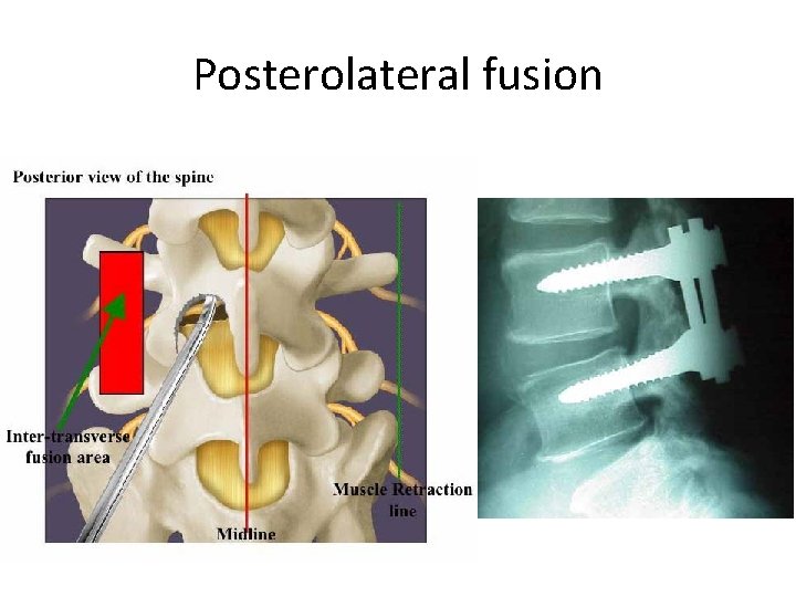 Posterolateral fusion 