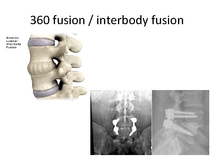 360 fusion / interbody fusion 