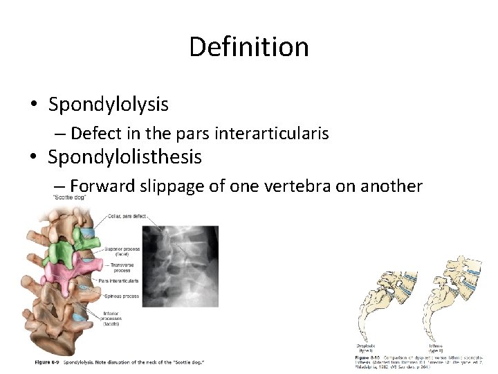 Definition • Spondylolysis – Defect in the pars interarticularis • Spondylolisthesis – Forward slippage