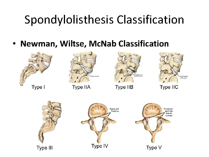 Spondylolisthesis Classification • Newman, Wiltse, Mc. Nab Classification 