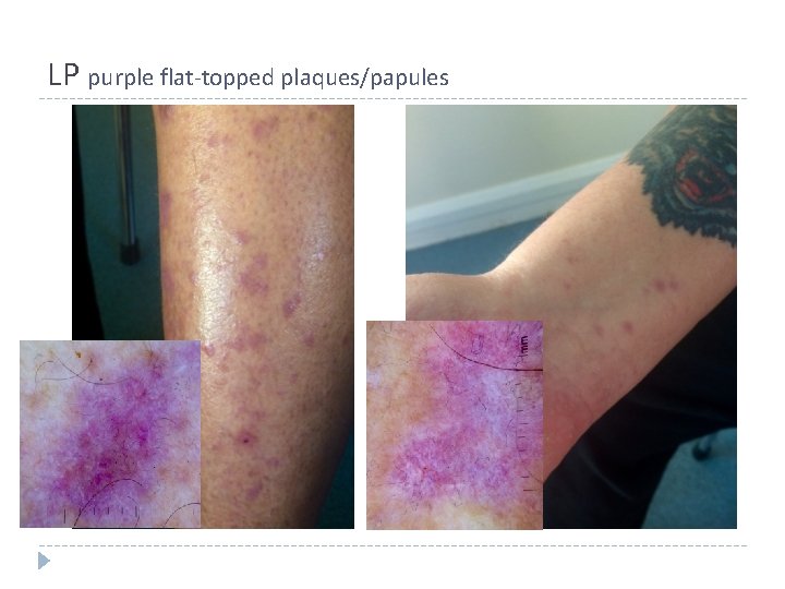 LP purple flat-topped plaques/papules LP purple flat-topped plaques/papules