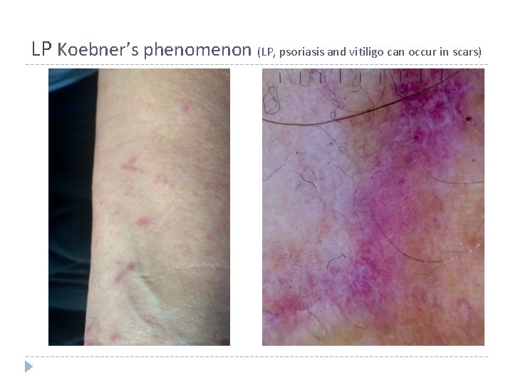 LP Koebner’s phenomenon (LP, psoriasis and vitiligo can occur in scars) LP Koebner’s phenomenon (LP, psoriasis and vitiligo can occur in scars)