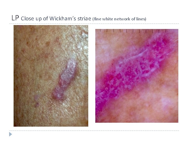 LP Close up of Wickham’s striae (fine white network of lines) LP Close up of Wickham’s striae (fine white network of lines)