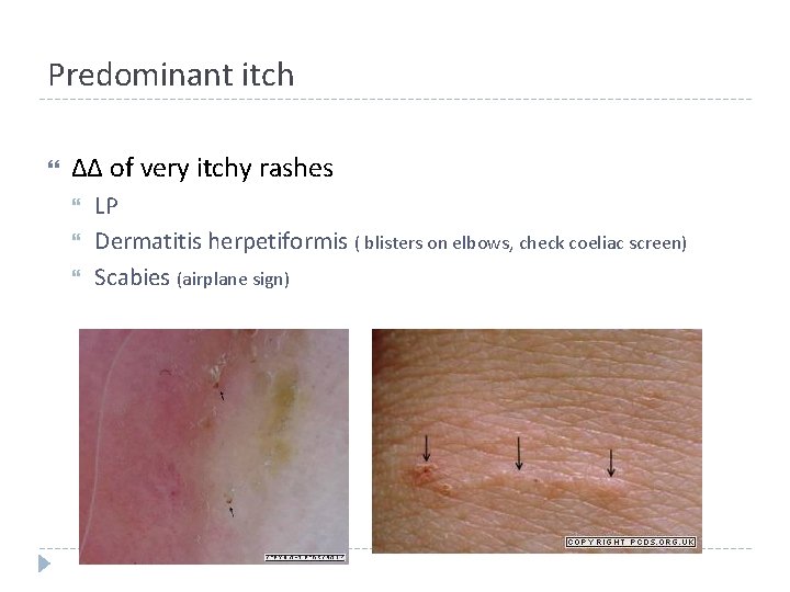 Predominant itch ΔΔ of very itchy rashes LP Dermatitis herpetiformis ( blisters on elbows, Predominant itch ΔΔ of very itchy rashes LP Dermatitis herpetiformis ( blisters on elbows,