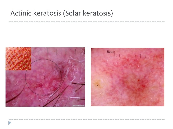 Actinic keratosis (Solar keratosis) Actinic keratosis (Solar keratosis)