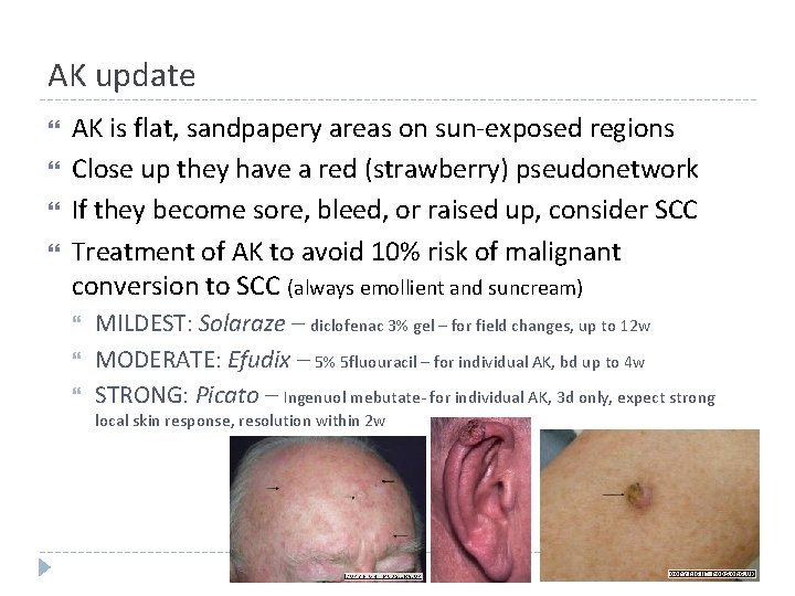 AK update AK is flat, sandpapery areas on sun-exposed regions Close up they have AK update AK is flat, sandpapery areas on sun-exposed regions Close up they have