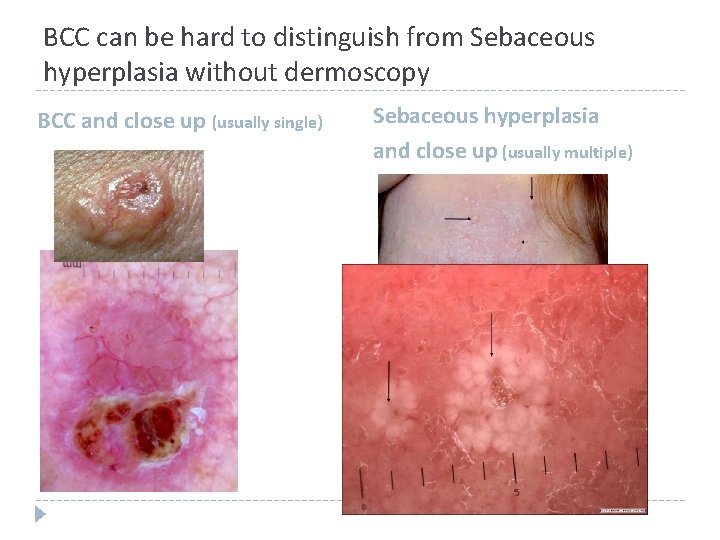 BCC can be hard to distinguish from Sebaceous hyperplasia without dermoscopy BCC and close BCC can be hard to distinguish from Sebaceous hyperplasia without dermoscopy BCC and close