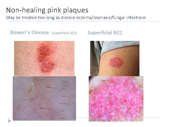 Non-healing pink plaques May be treated too long as discoid eczema/psoriasis/fungal infections Bowen’s Disease Non-healing pink plaques May be treated too long as discoid eczema/psoriasis/fungal infections Bowen’s Disease