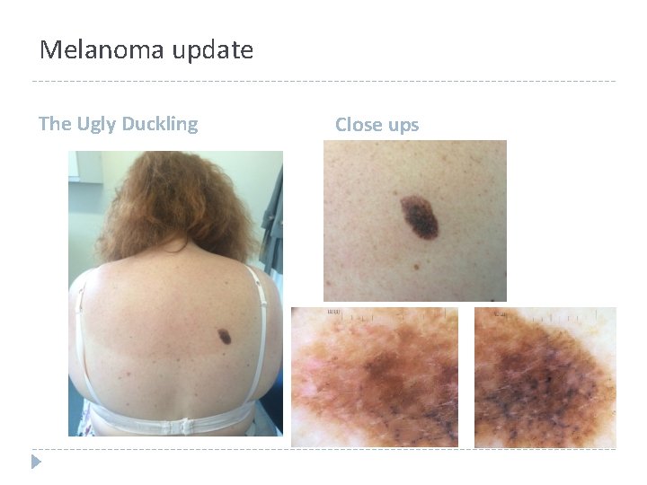 Melanoma update The Ugly Duckling Close ups Melanoma update The Ugly Duckling Close ups