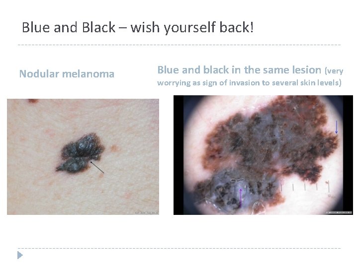 Blue and Black – wish yourself back! Nodular melanoma Blue and black in the Blue and Black – wish yourself back! Nodular melanoma Blue and black in the