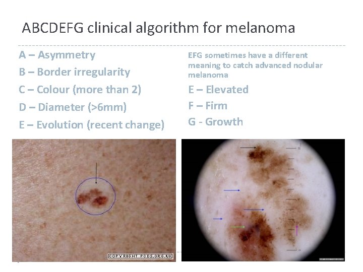 ABCDEFG clinical algorithm for melanoma A – Asymmetry B – Border irregularity C – ABCDEFG clinical algorithm for melanoma A – Asymmetry B – Border irregularity C –