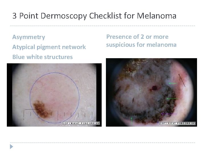 3 Point Dermoscopy Checklist for Melanoma Asymmetry Atypical pigment network Blue white structures Presence 3 Point Dermoscopy Checklist for Melanoma Asymmetry Atypical pigment network Blue white structures Presence