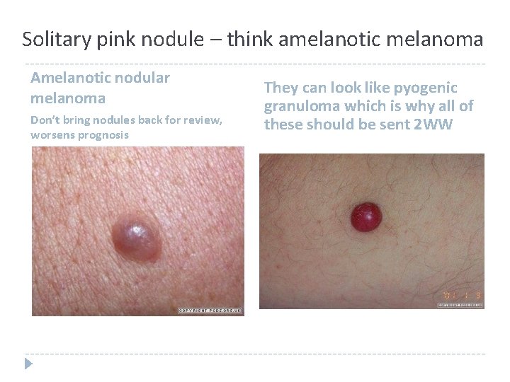 Solitary pink nodule – think amelanotic melanoma Amelanotic nodular melanoma Don’t bring nodules back Solitary pink nodule – think amelanotic melanoma Amelanotic nodular melanoma Don’t bring nodules back