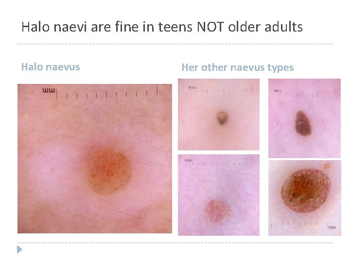 Halo naevi are fine in teens NOT older adults Halo naevus Her other naevus Halo naevi are fine in teens NOT older adults Halo naevus Her other naevus