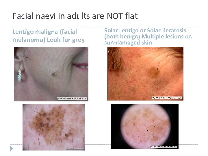 Facial naevi in adults are NOT flat Lentigo maligna (facial melanoma) Look for grey Facial naevi in adults are NOT flat Lentigo maligna (facial melanoma) Look for grey