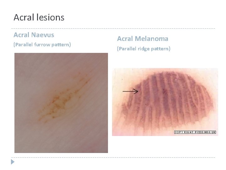 Acral lesions Acral Naevus (Parallel furrow pattern) Acral Melanoma (Parallel ridge pattern) Acral lesions Acral Naevus (Parallel furrow pattern) Acral Melanoma (Parallel ridge pattern)