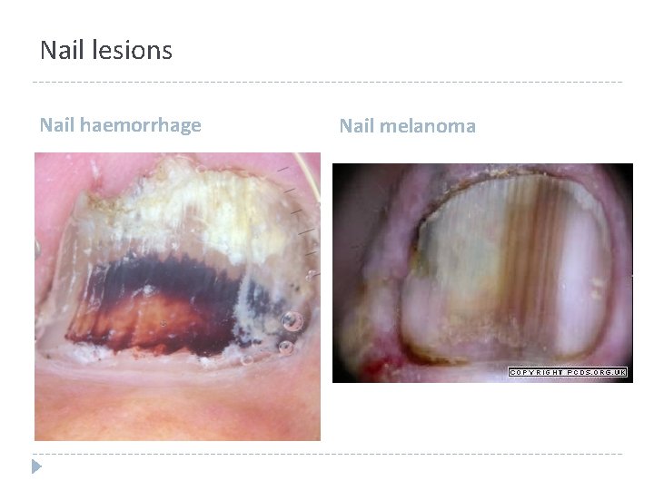 Nail lesions Nail haemorrhage Nail melanoma Nail lesions Nail haemorrhage Nail melanoma