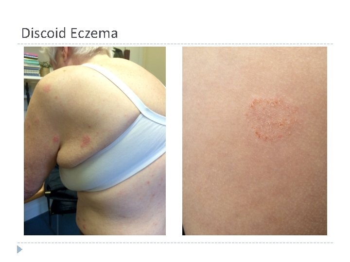 Discoid Eczema Discoid Eczema