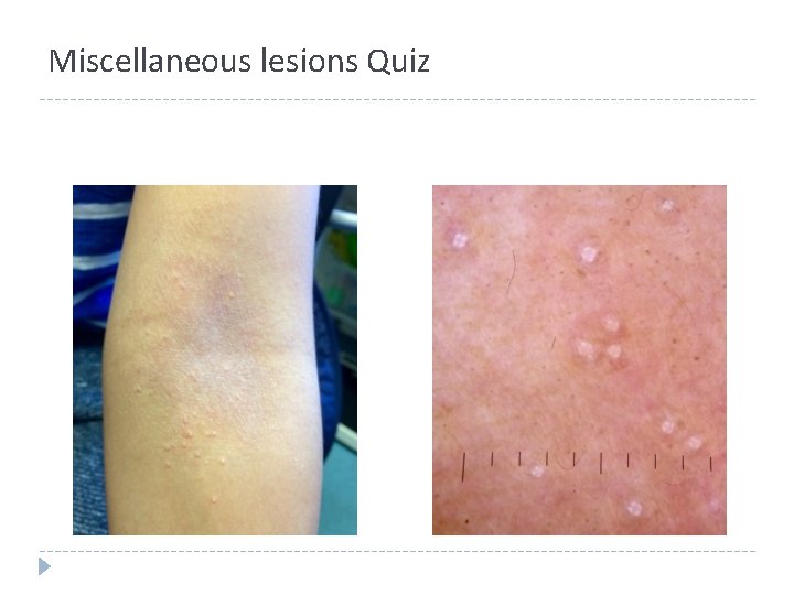 Miscellaneous lesions Quiz Miscellaneous lesions Quiz