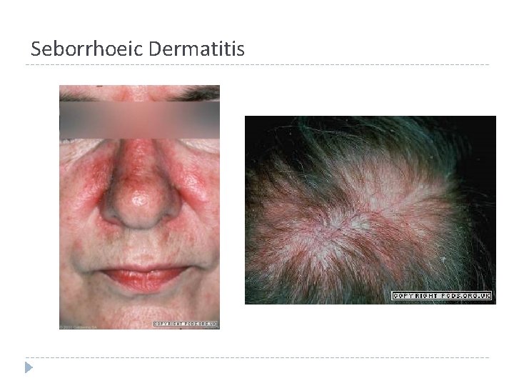 Seborrhoeic Dermatitis Seborrhoeic Dermatitis