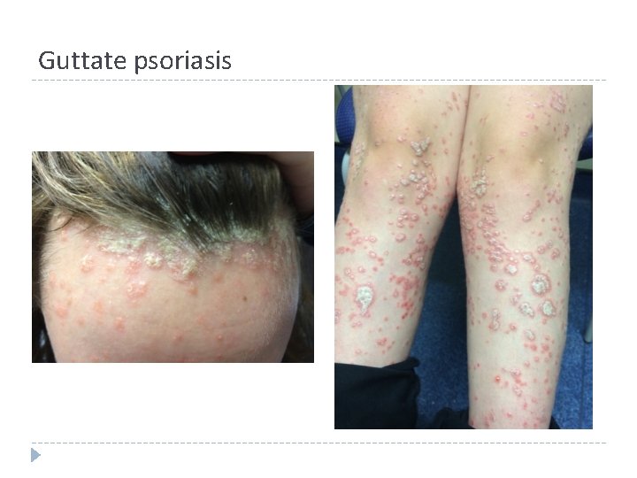 Guttate psoriasis Guttate psoriasis