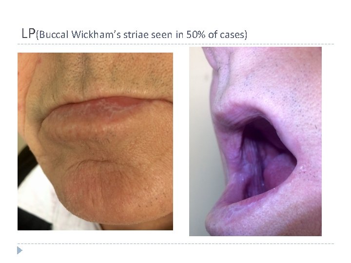 LP(Buccal Wickham’s striae seen in 50% of cases) LP(Buccal Wickham’s striae seen in 50% of cases)