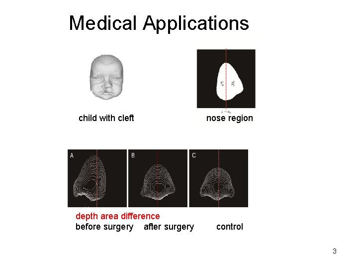 Medical Applications child with cleft depth area difference before surgery after surgery nose region Medical Applications child with cleft depth area difference before surgery after surgery nose region