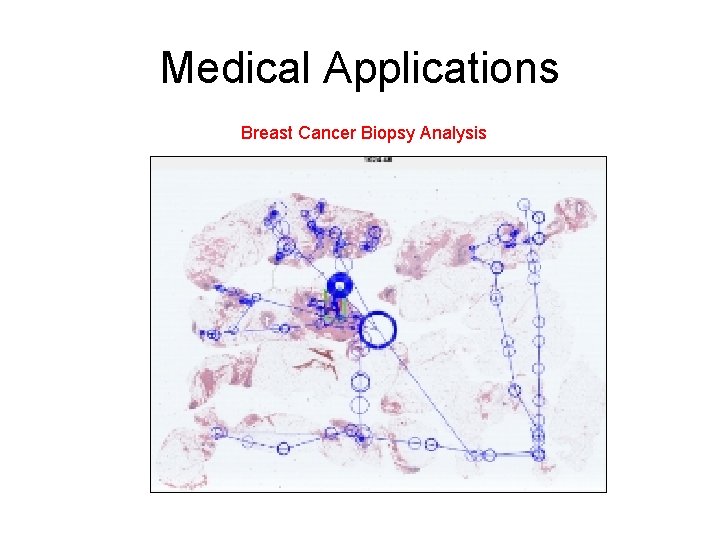 Medical Applications Breast Cancer Biopsy Analysis Medical Applications Breast Cancer Biopsy Analysis