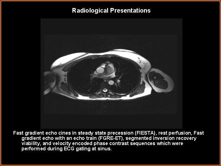 Radiological Presentations Fast gradient echo cines in steady state precession (FIESTA), rest perfusion, Fast