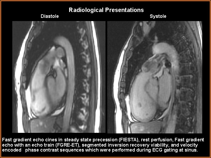 Radiological Presentations Diastole Systole Fast gradient echo cines in steady state precession (FIESTA), rest