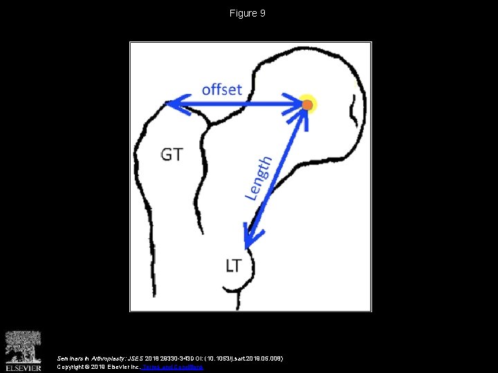 Figure 9 Seminars in Arthroplasty: JSES 2018 29330 -343 DOI: (10. 1053/j. sart. 2019.