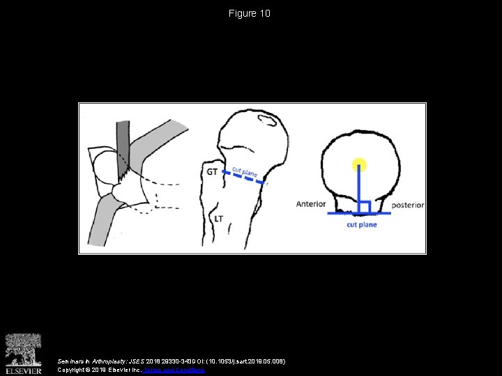 Figure 10 Seminars in Arthroplasty: JSES 2018 29330 -343 DOI: (10. 1053/j. sart. 2019.