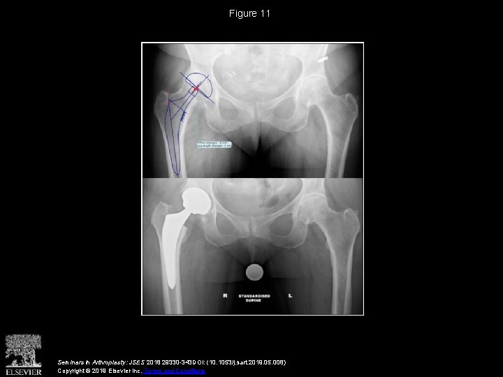 Figure 11 Seminars in Arthroplasty: JSES 2018 29330 -343 DOI: (10. 1053/j. sart. 2019.