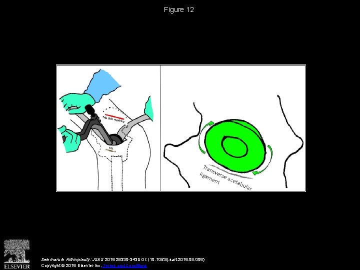 Figure 12 Seminars in Arthroplasty: JSES 2018 29330 -343 DOI: (10. 1053/j. sart. 2019.