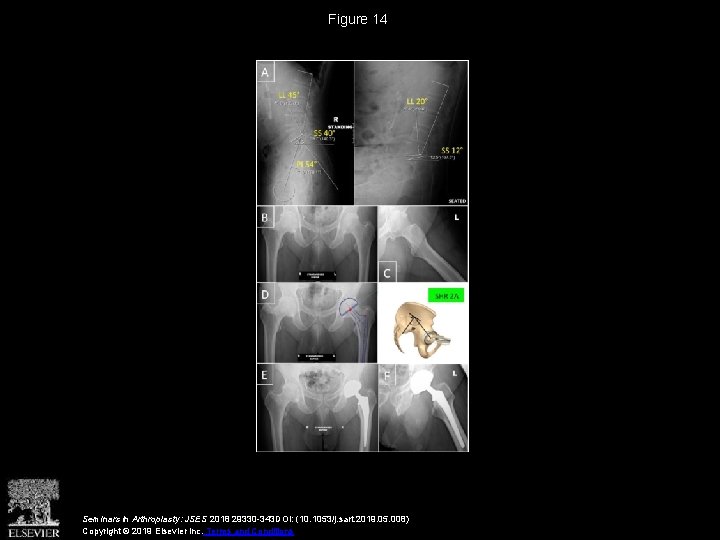 Figure 14 Seminars in Arthroplasty: JSES 2018 29330 -343 DOI: (10. 1053/j. sart. 2019.