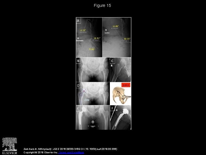 Figure 15 Seminars in Arthroplasty: JSES 2018 29330 -343 DOI: (10. 1053/j. sart. 2019.