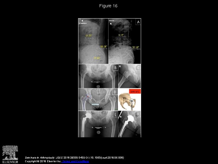 Figure 16 Seminars in Arthroplasty: JSES 2018 29330 -343 DOI: (10. 1053/j. sart. 2019.