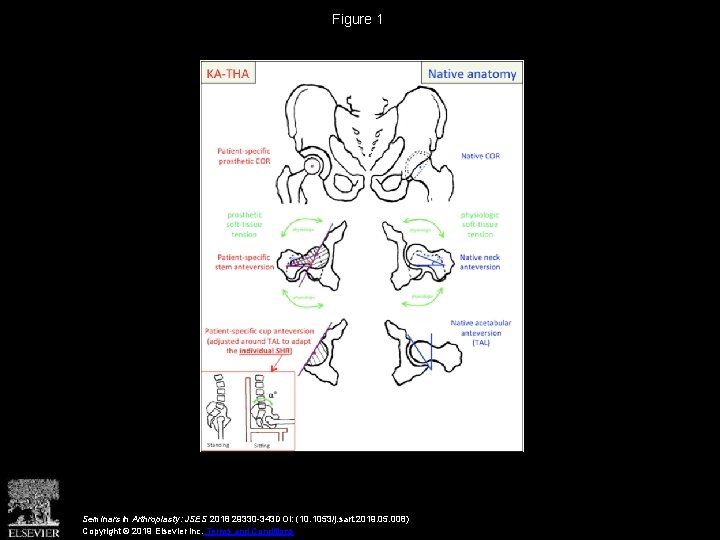 Figure 1 Seminars in Arthroplasty: JSES 2018 29330 -343 DOI: (10. 1053/j. sart. 2019.