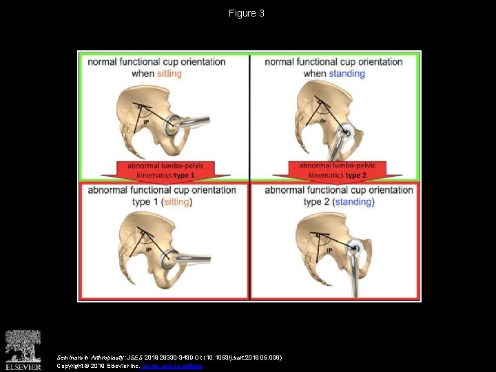 Figure 3 Seminars in Arthroplasty: JSES 2018 29330 -343 DOI: (10. 1053/j. sart. 2019.