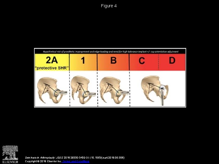 Figure 4 Seminars in Arthroplasty: JSES 2018 29330 -343 DOI: (10. 1053/j. sart. 2019.